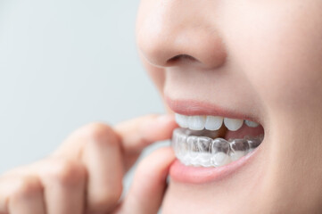 Woman wearing orthodontic silicone trainer. Mobile orthodontic appliance for dental correction. tooth whitening systems.