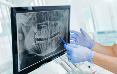 Hands doctor dentist in gloves show the teeth on x-ray on digital screen in dental clinic on light background with medical equipment. Smile healthy teeth concept, close up