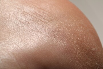 Man with dry skin on his heel against light background, closeup