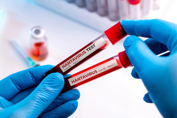 Two hantavirus blood samples representing infectious disease screening concept